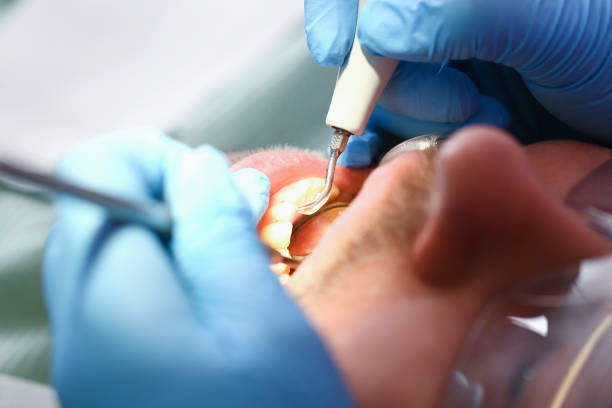 Best Knocked-Out Tooth (Avulsed Tooth) Treatment in San Marcos, CA