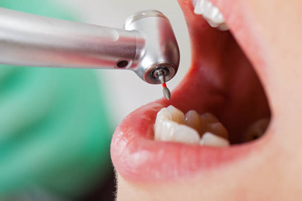 Best Lost Filling or Crown Replacement in San Marcos, CA